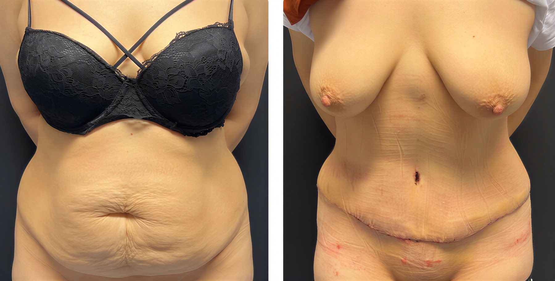 Resultados de abdominoplastia antes y después en Aktip Hospital – mejora del contorno abdominal