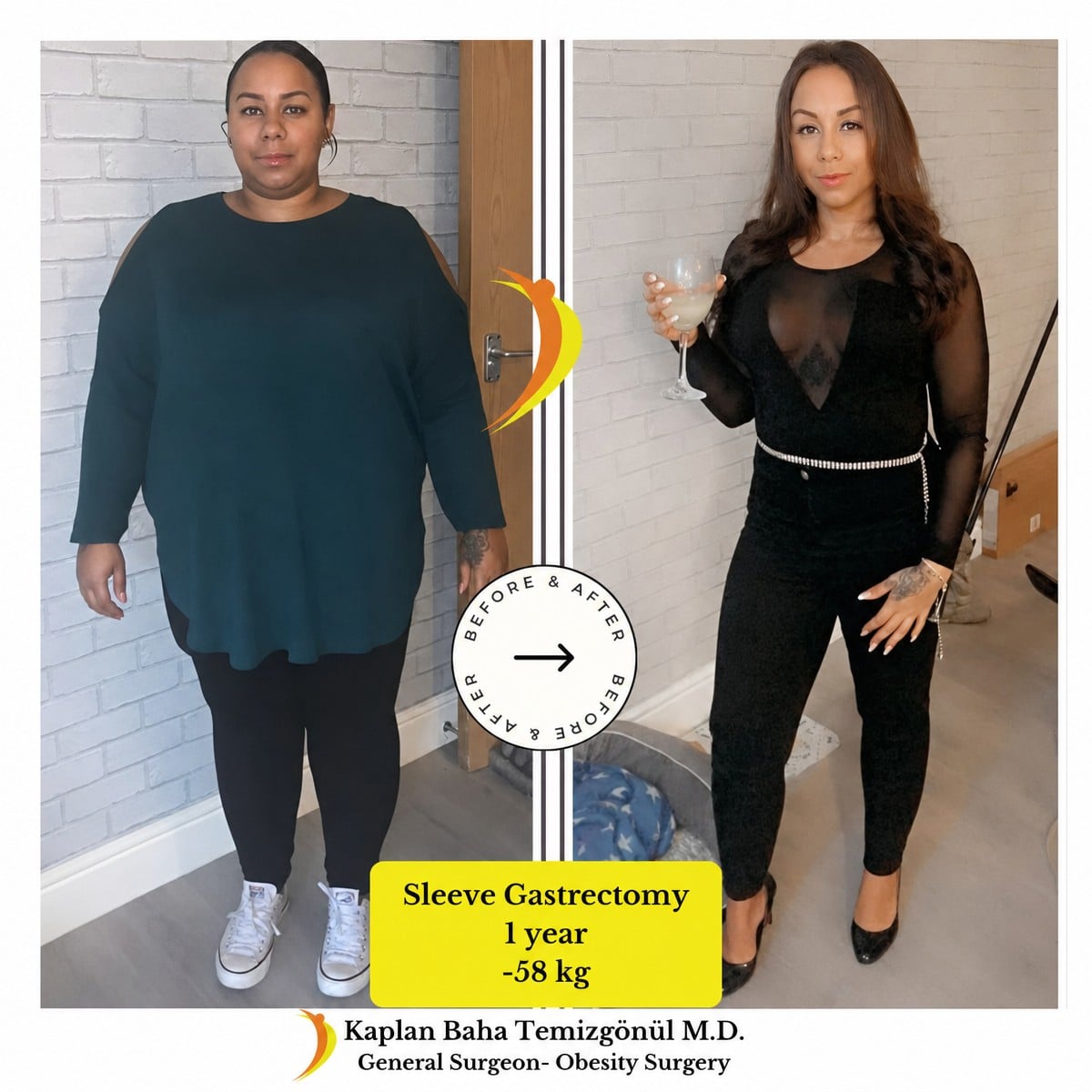نتائج قبل وبعد تكميم المعدة في Lotus Bariatrics Clinic، فقدان 58 كجم