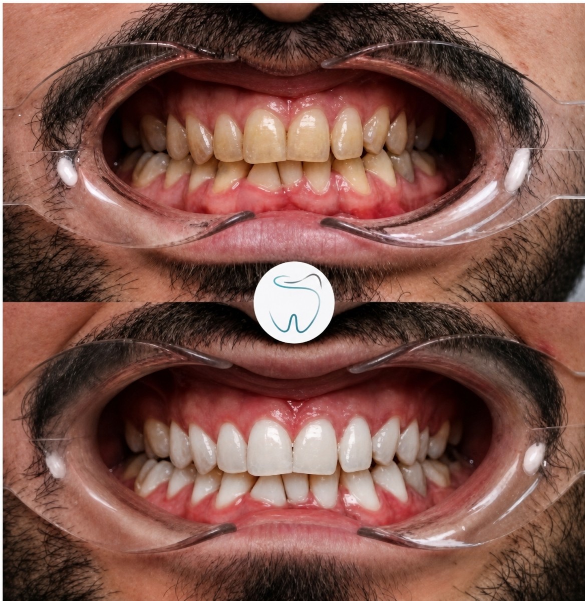 Resultados antes y después de blanqueamiento dental láser en Megadentist Oral & Dental Aesthetıc Dentistry