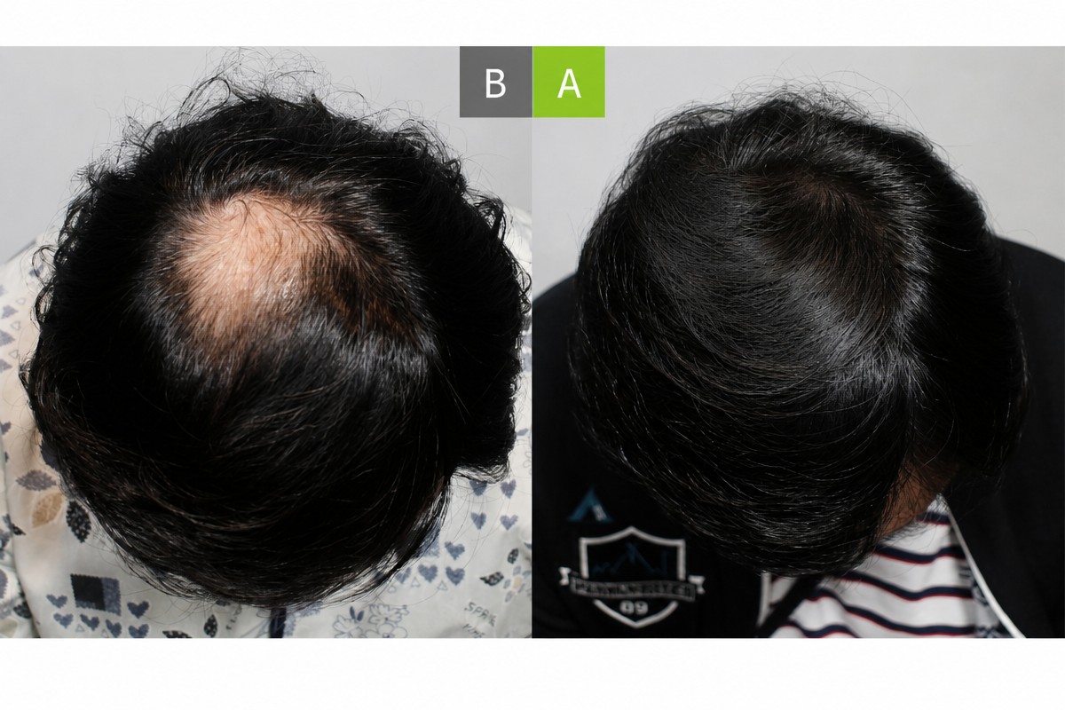 نتائج زراعة الشعر بدون حلاقة قبل وبعد في MOAMAN Hair Transplant Clinic، منطقة التاج