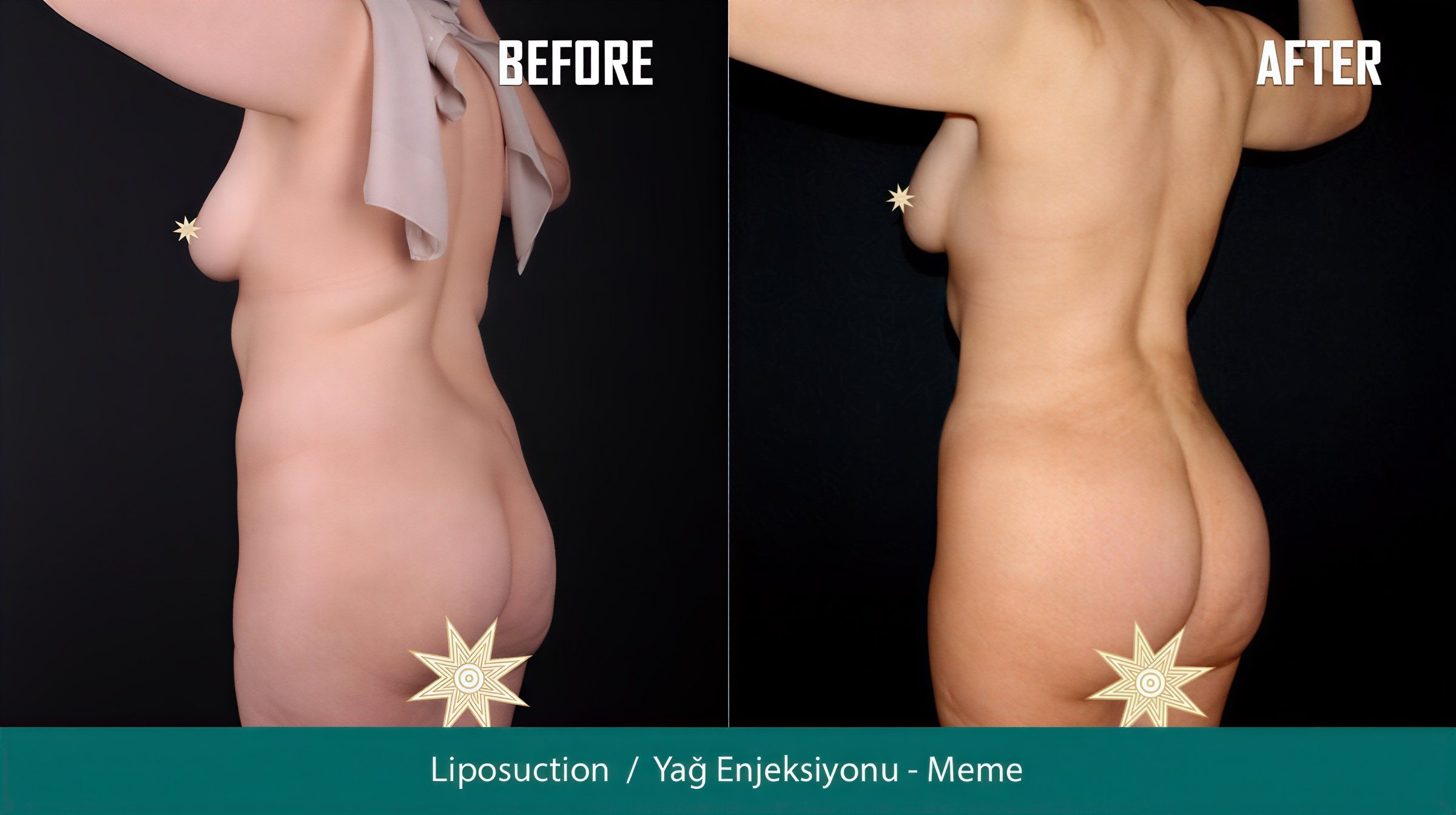 Resultados antes y después de Brazilian Butt Lift en Quartz Hospital, contorno corporal mejorado