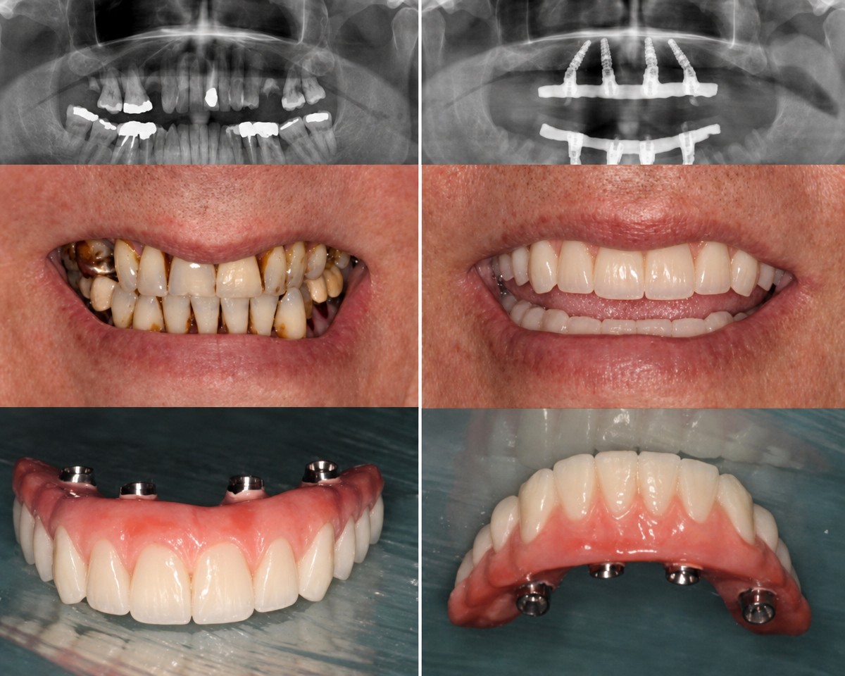 نتيجة قبل وبعد زراعة الأسنان All-on-4 في White Dental Turkey، استعادة الابتسامة