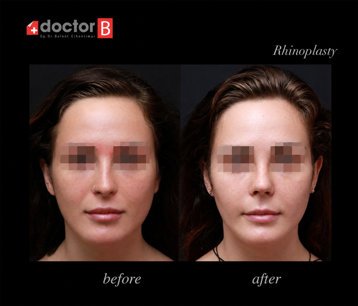 Resultados de rinoplastia antes y después en Doctor B Clinic, remodelación nasal natural