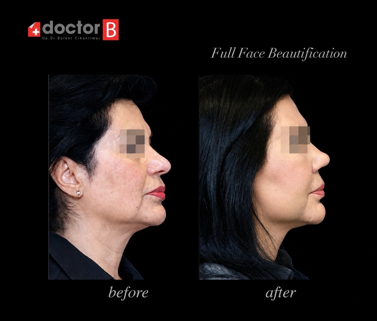 نتائج تجميل الوجه الكامل قبل وبعد في Doctor B Clinic، تحسين ملامح الوجه