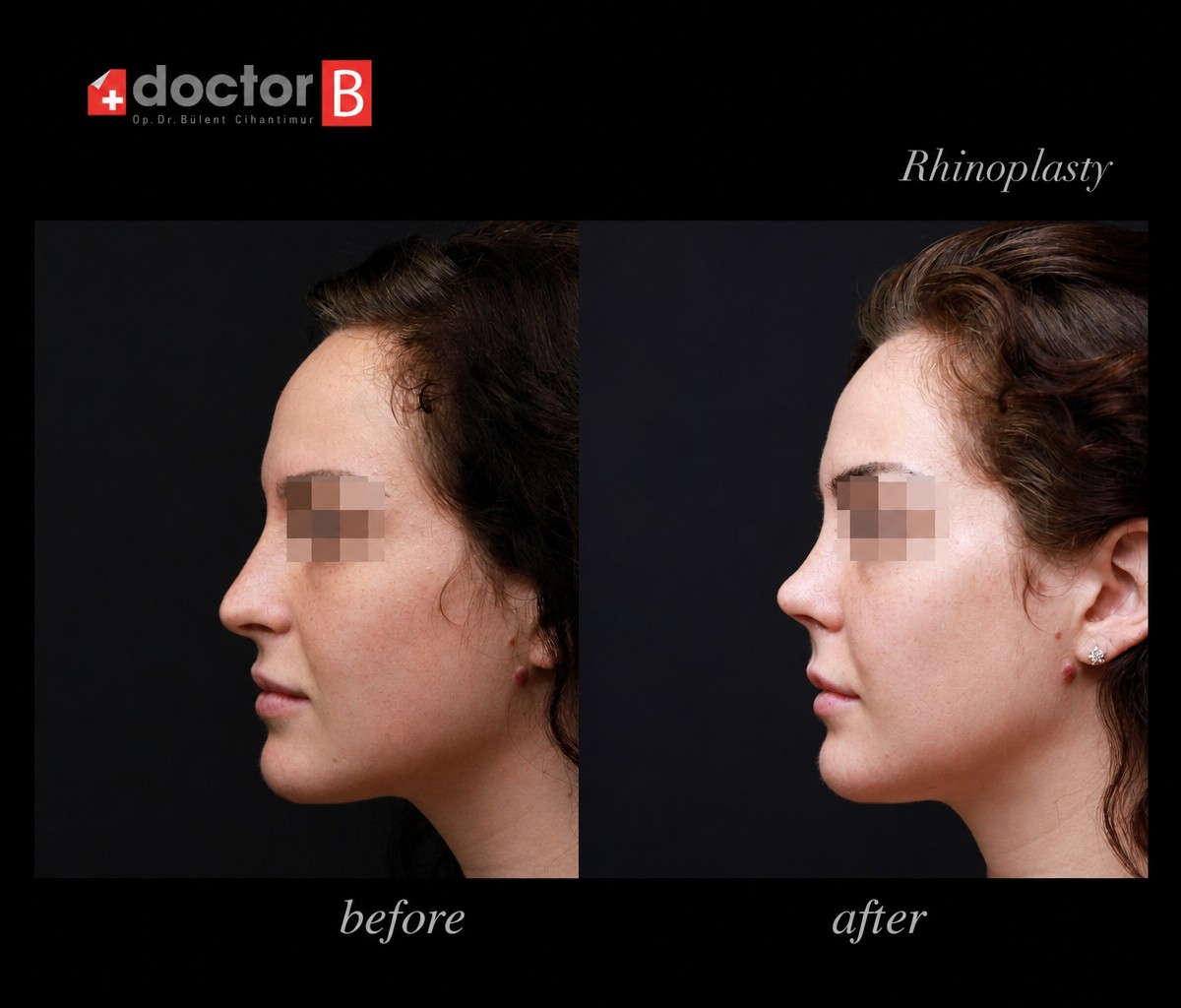 نتائج تجميل الأنف قبل وبعد في Doctor B Clinic، إعادة تشكيل الأنف بمظهر طبيعي