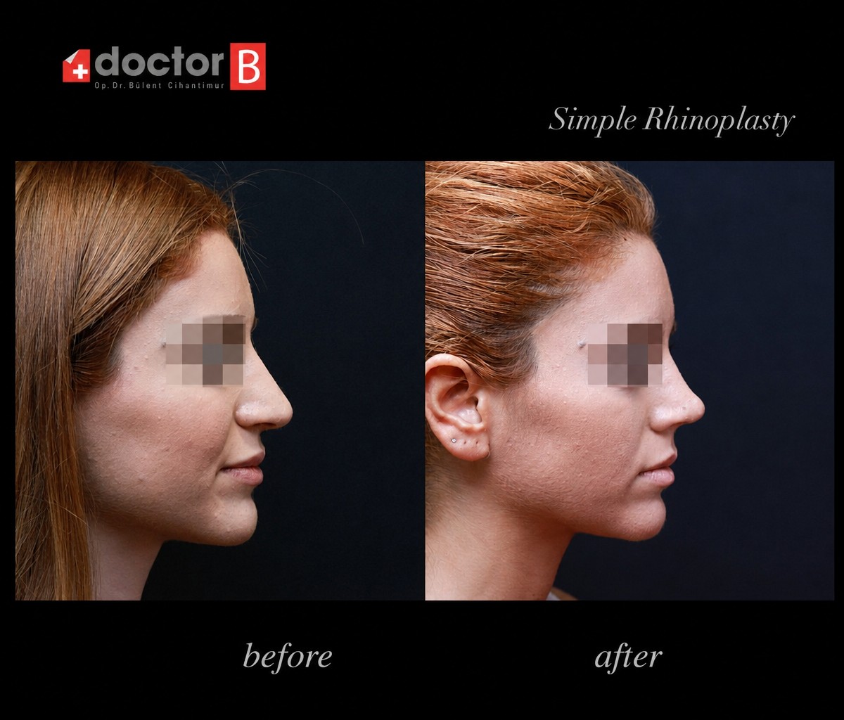 نتائج تجميل الأنف قبل وبعد في Doctor B Clinic، إعادة تشكيل الأنف بمظهر طبيعي