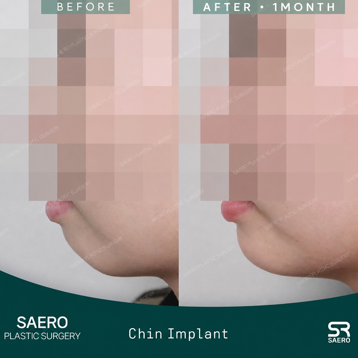 نتائج قبل وبعد زراعة الذقن في SAERO Plastic Surgery، تحسين شكل الذقن