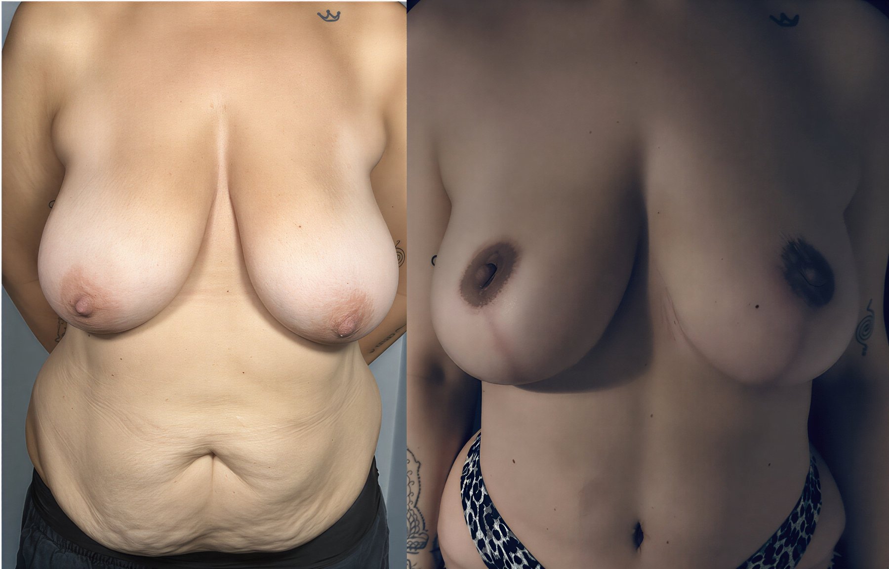 Resultados antes y después de mastopexia en Prof. Furkan Karabekmez's Aesthetic Surgery Clinic