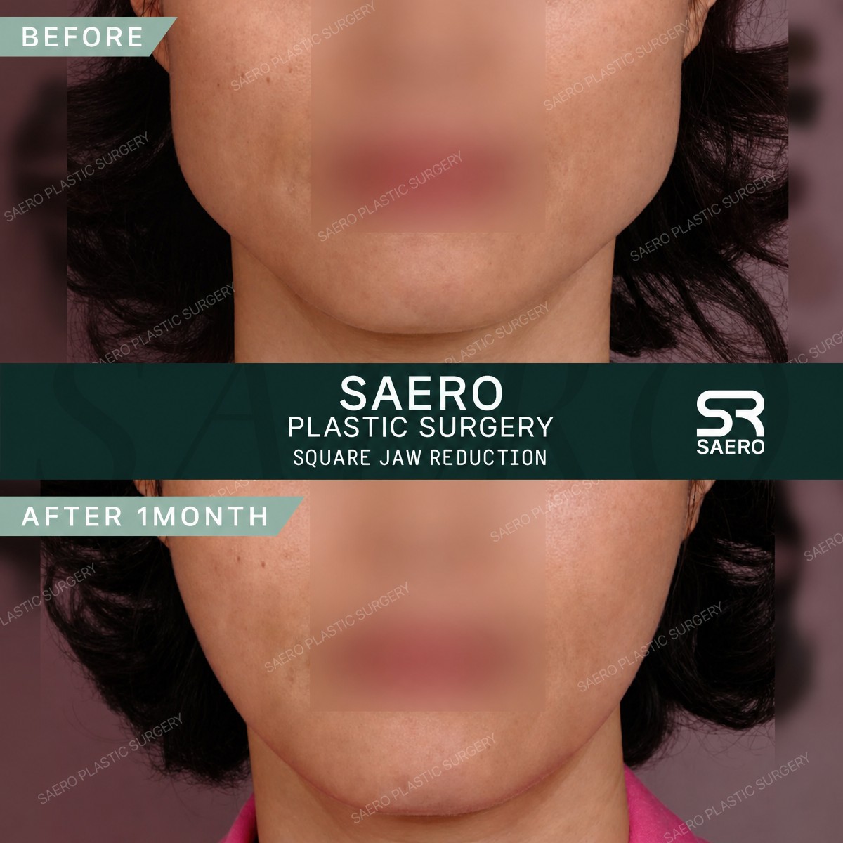 قبل وبعد تشكيل الفك في SAERO Plastic Surgery – نتيجة تقليل الفك واضحة
