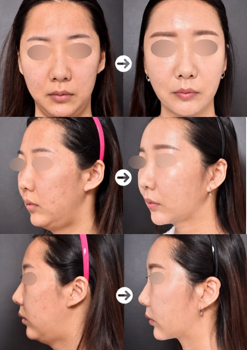 نتائج نحت الدهون للوجه في VG Plastic Surgery، تحديد الفك وتجميل الملامح