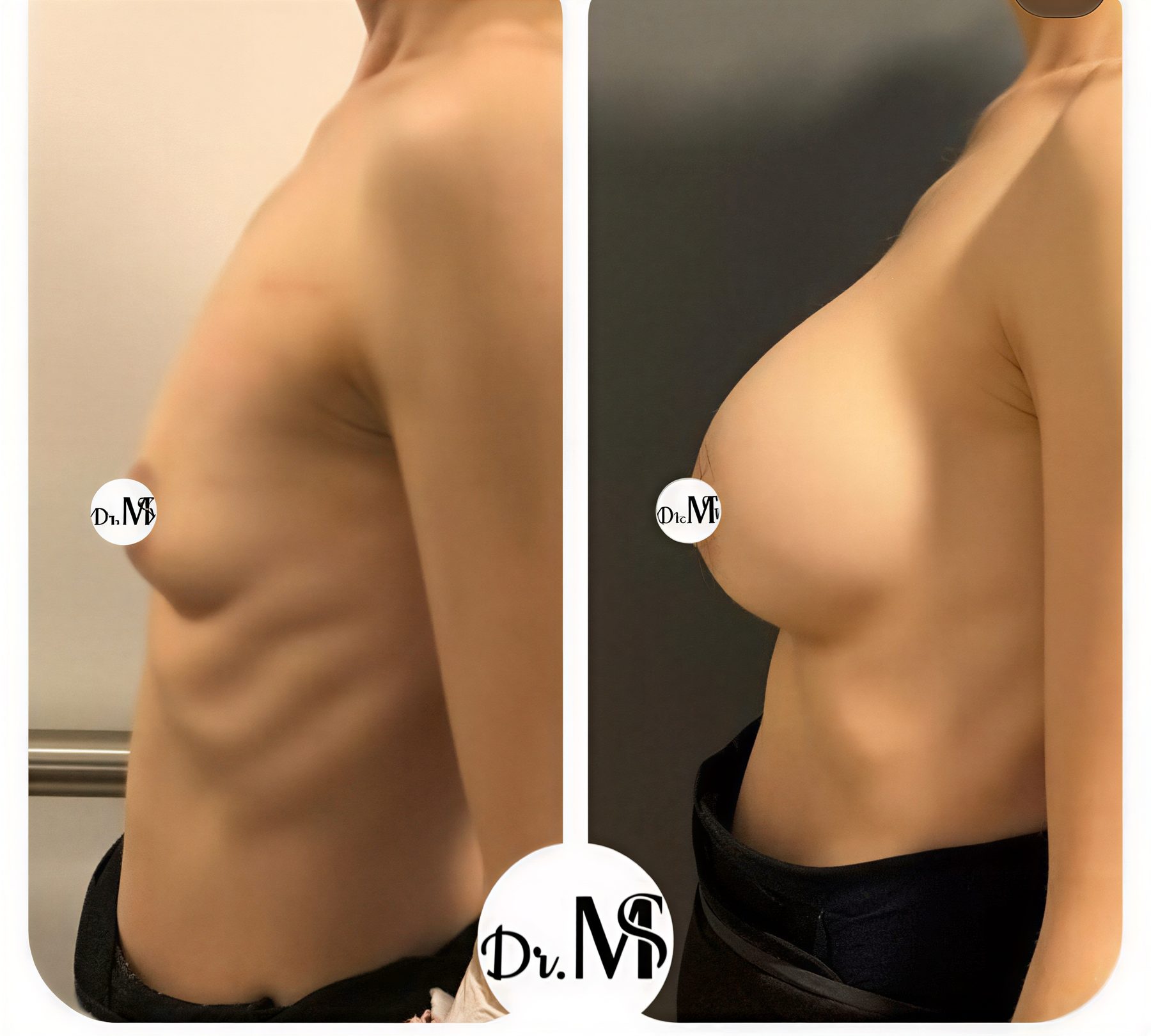 Resultados antes y después de lifting de senos en MERT SECER AESTHETIC AND PLASTIC SURGEON