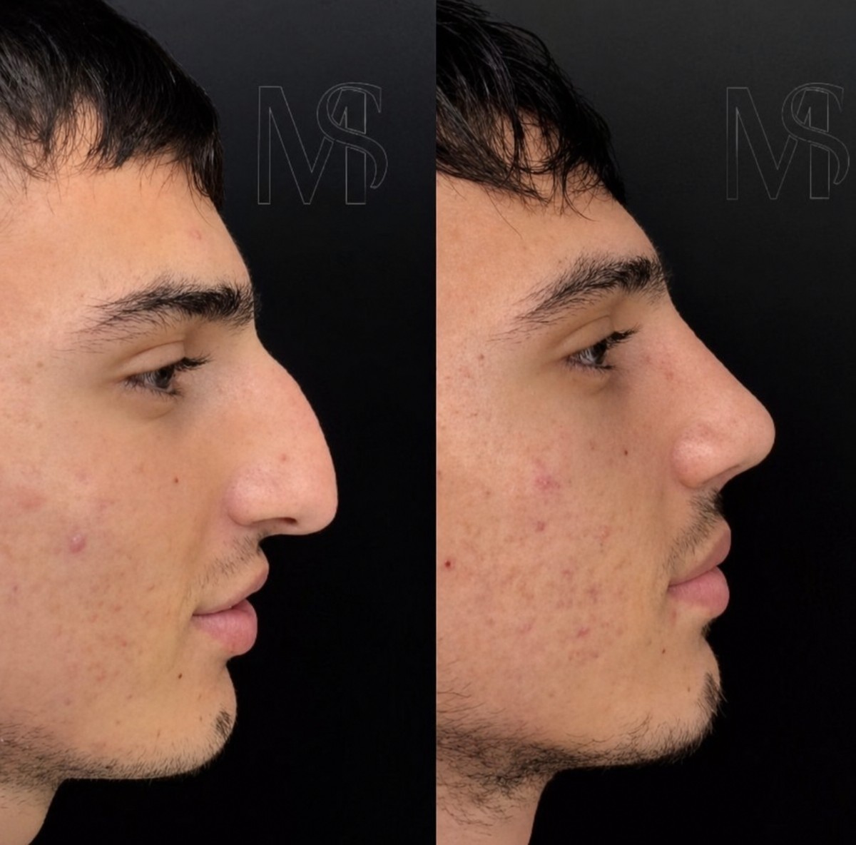 نتائج تجميل الأنف قبل وبعد في MERT SECER AESTHETIC AND PLASTIC SURGEON، إعادة تشكيل الأنف