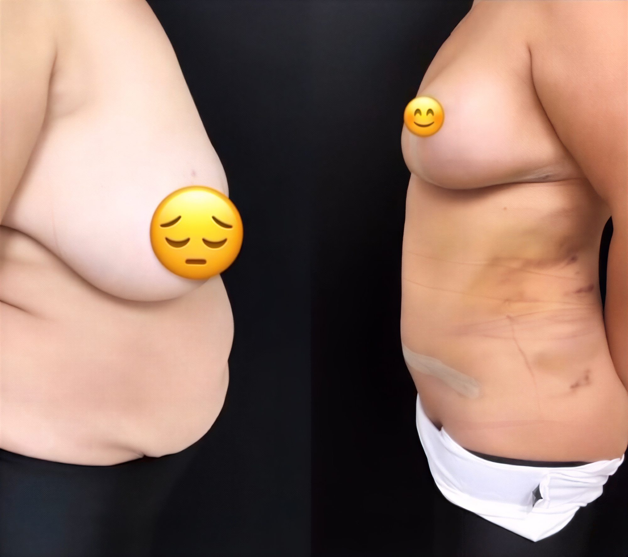 نتائج شفط الدهون قبل وبعد في MERT SECER AESTHETIC AND PLASTIC SURGEON، نحت الجسم