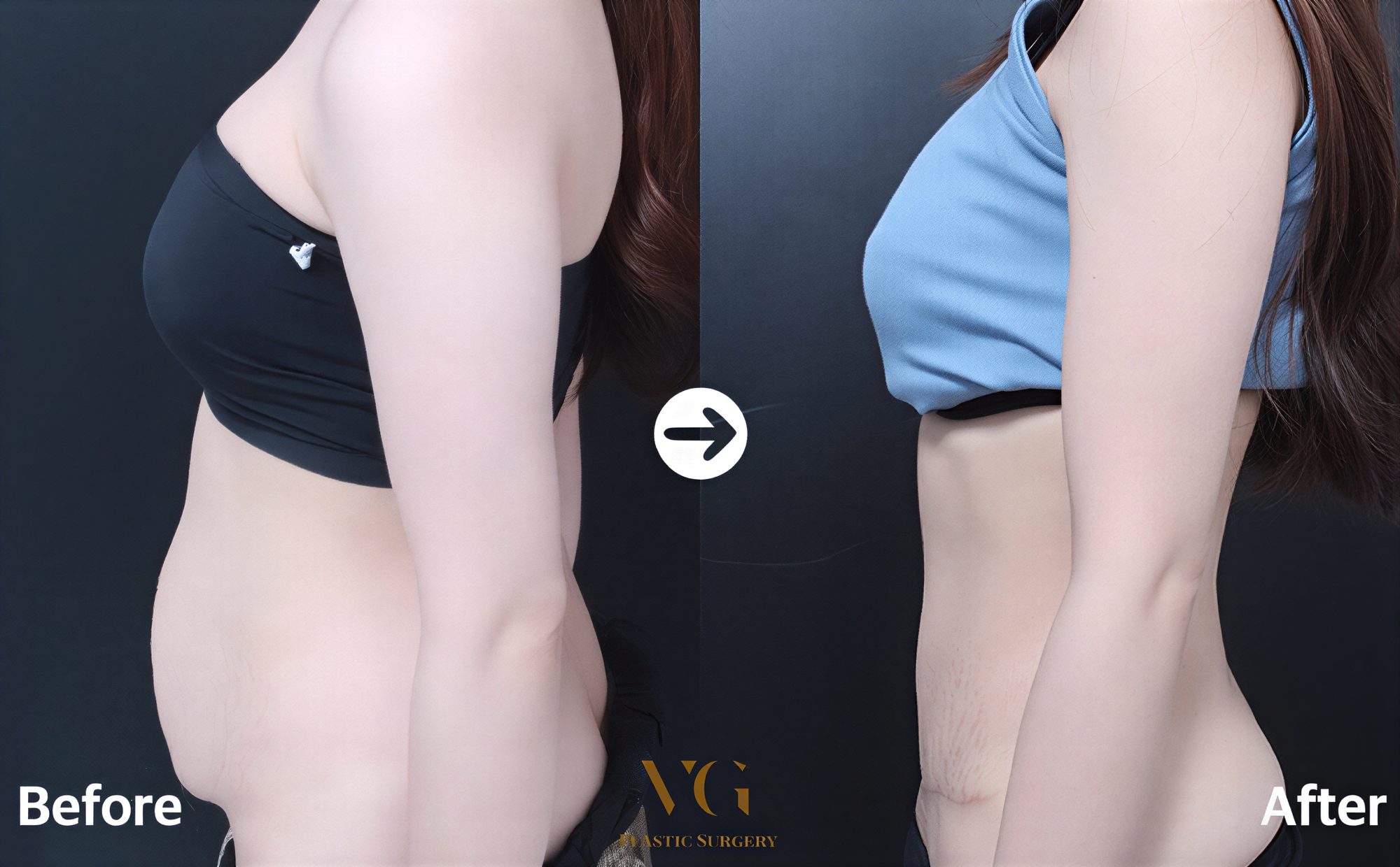 Resultados de abdominoplastia y liposucción antes y después en VG Plastic Surgery, abdomen plano