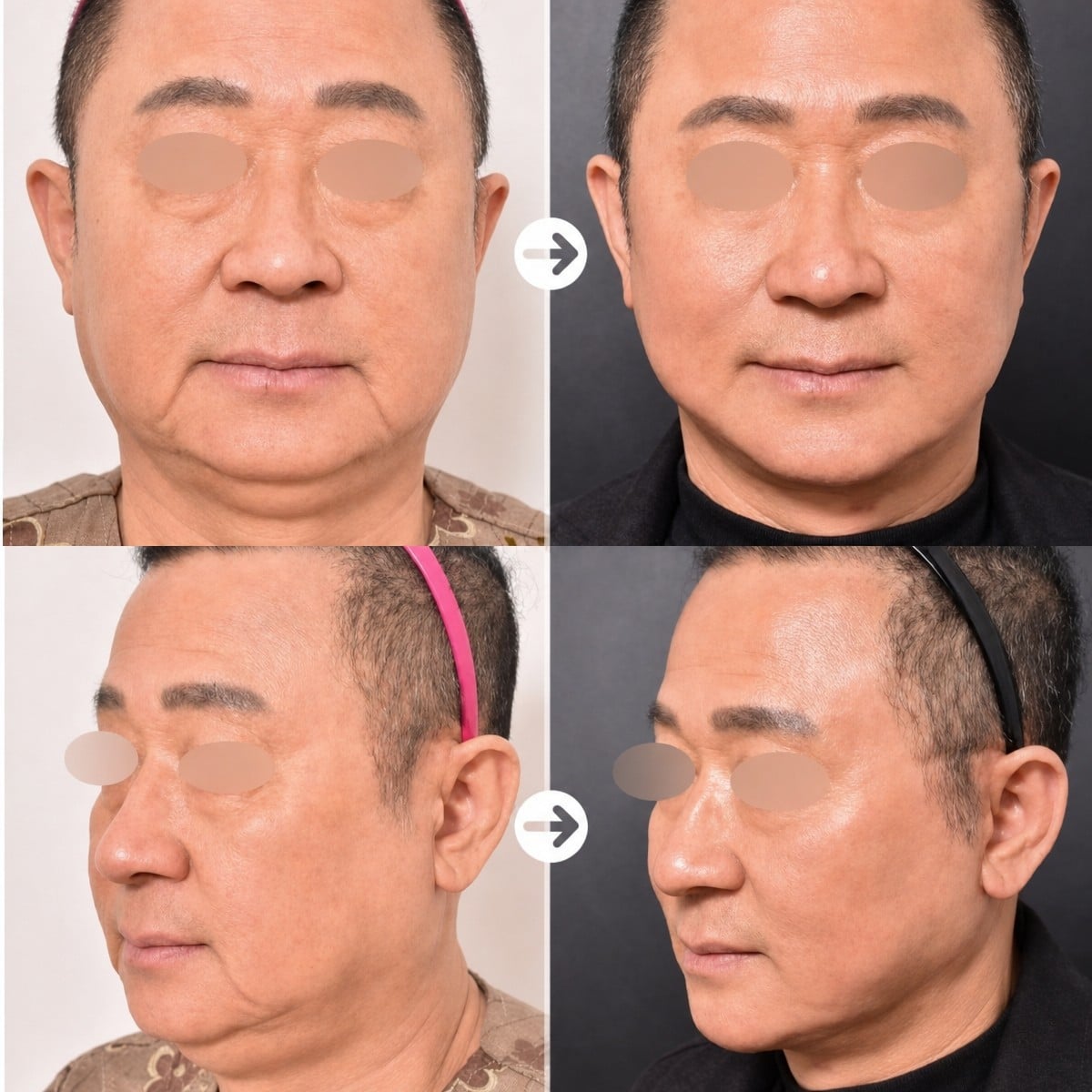 نتائج قبل وبعد تشكيل الفك في VG Plastic Surgery مع تحسين ملامح الوجه