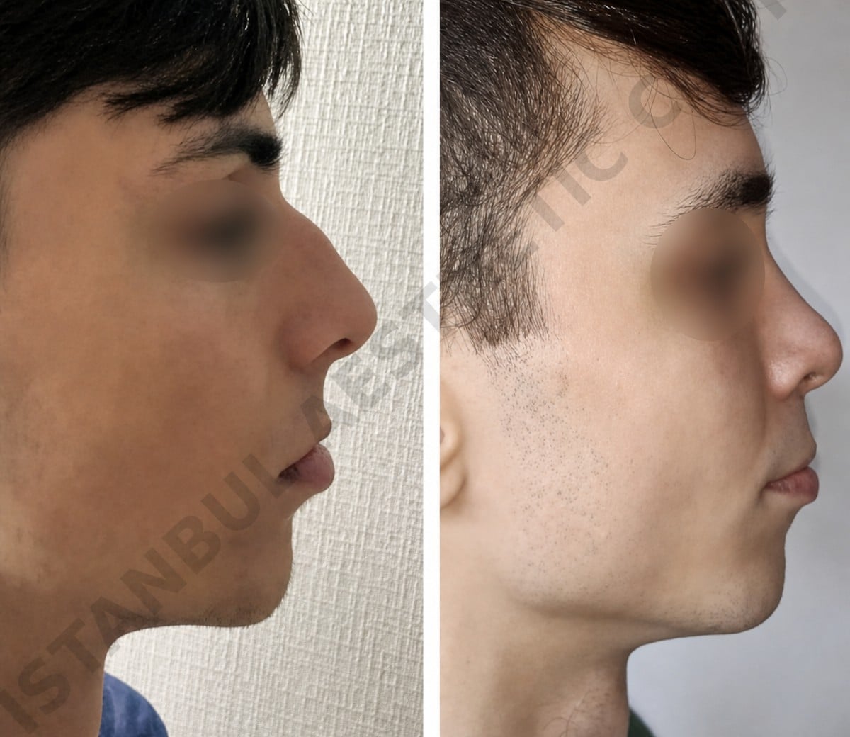 نتائج تجميل الأنف قبل وبعد في مركز إسطنبول لجراحة التجميل، إعادة تشكيل الأنف