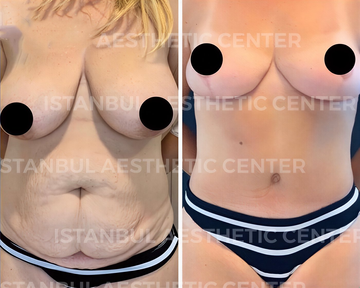 Resultados de lifting de senos y abdominoplastia antes y después en Istanbul Aesthetic Plastic Surgery Center