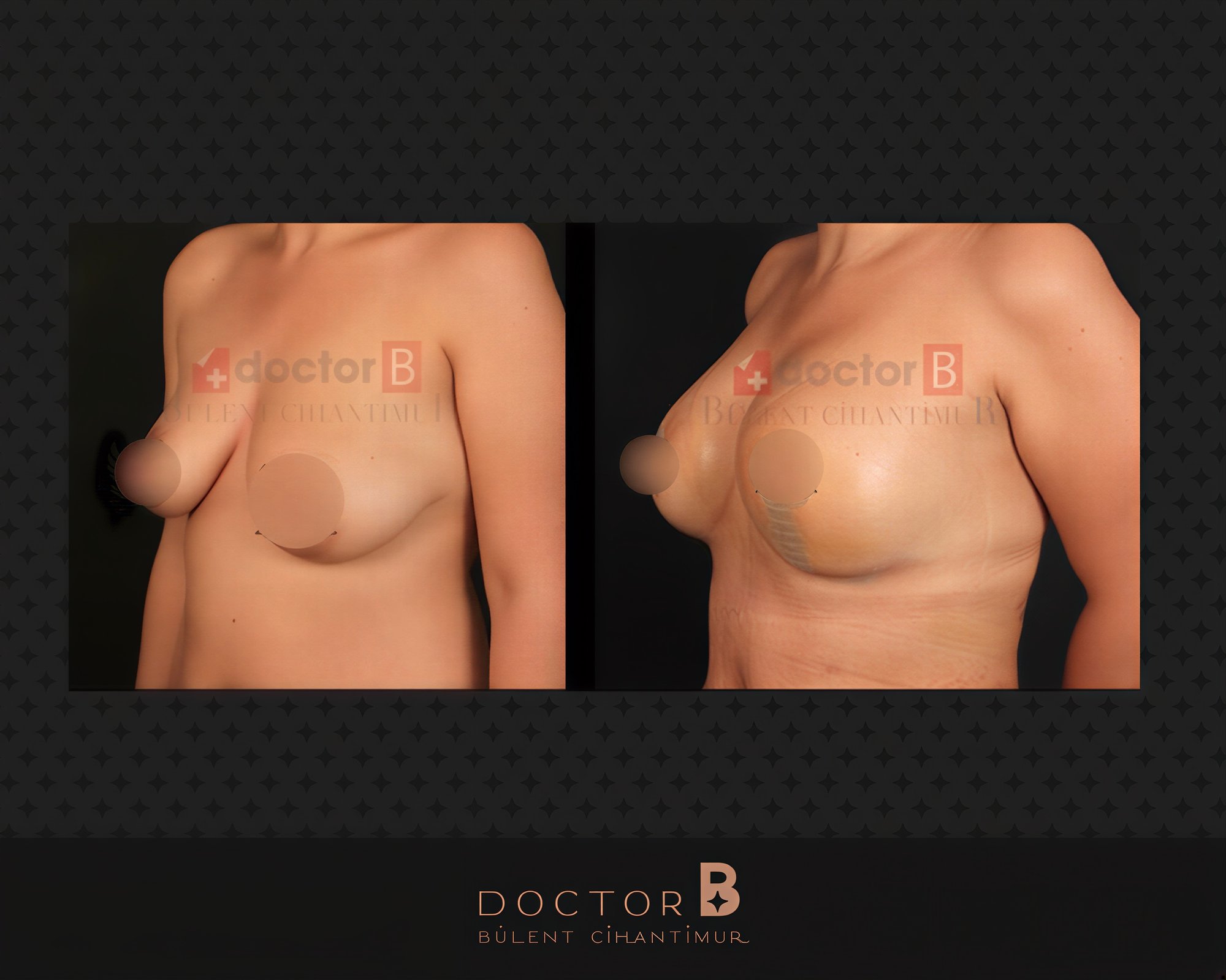 Resultados antes y después de implantes mamarios con lifting en Doctor B Clinic, mejor forma