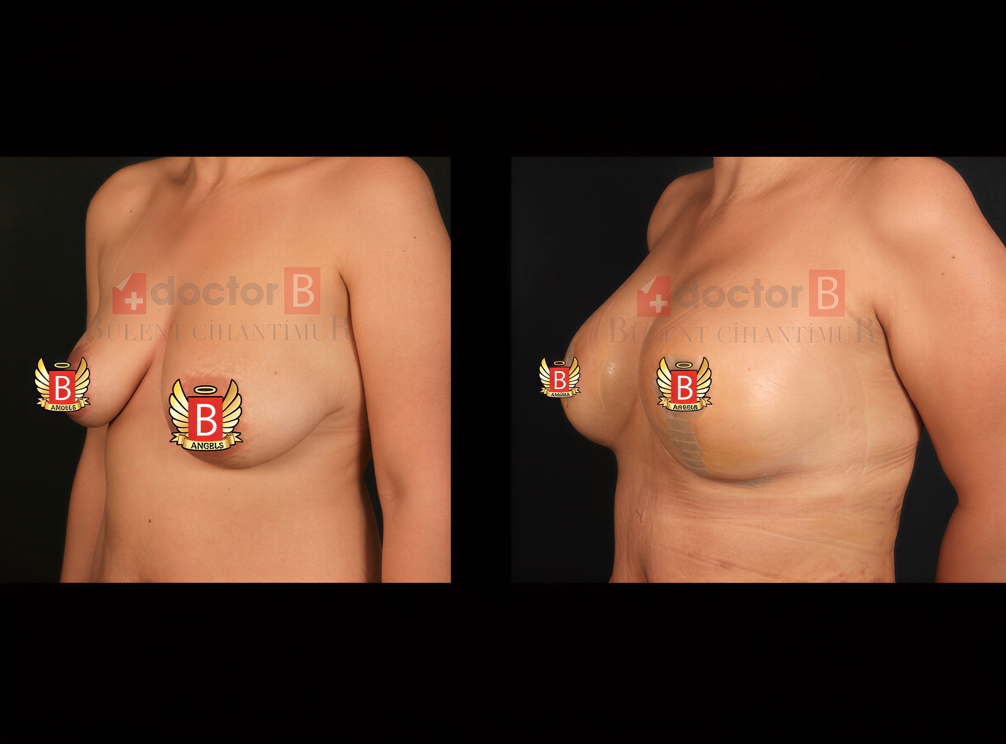 Resultados antes y después de implantes y levantamiento de senos en Doctor B Clinic