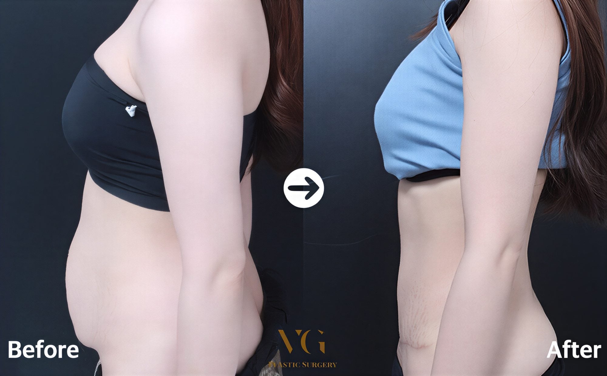نتائج شد البطن قبل وبعد في VG Plastic Surgery – بطن مسطح ومشدود