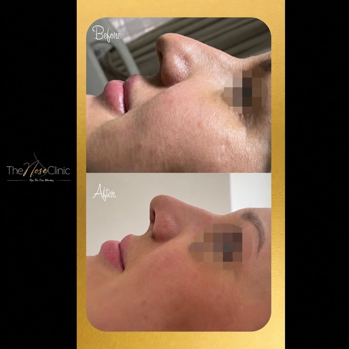 Resultados de rinoplastia antes y después en The Nose Clinic, perfil nasal mejorado