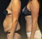 Before and after tummy tuck results at Memorial Şişli Hospital, improved abdominal contour