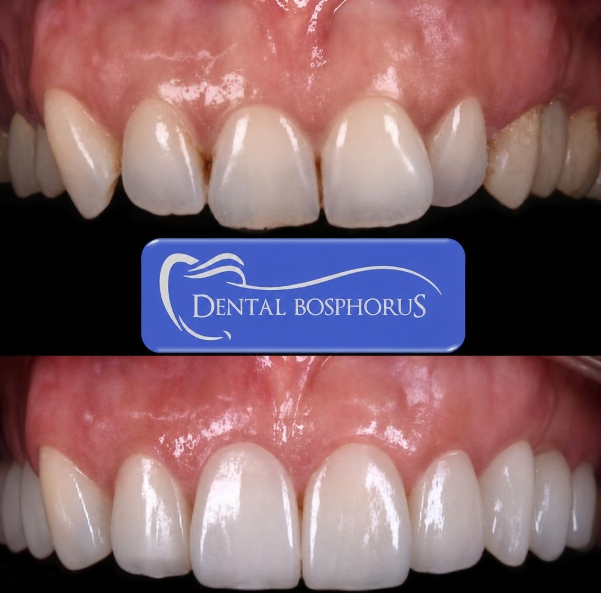 نتائج قبل وبعد فينير إيماكس في Dental Bosphorus – تحسين جمالية الابتسامة