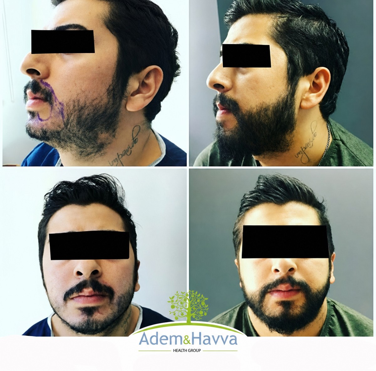 نتائج زراعة اللحية قبل وبعد في مركز آدم وحواء الطبي، لحية أكثر كثافة