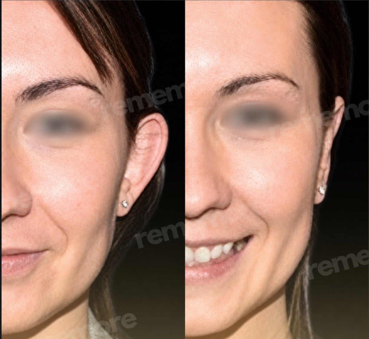 نتائج عملية تجميل الأذن قبل وبعد في مستشفى ميموريال شيشلي، تصحيح شكل الأذن