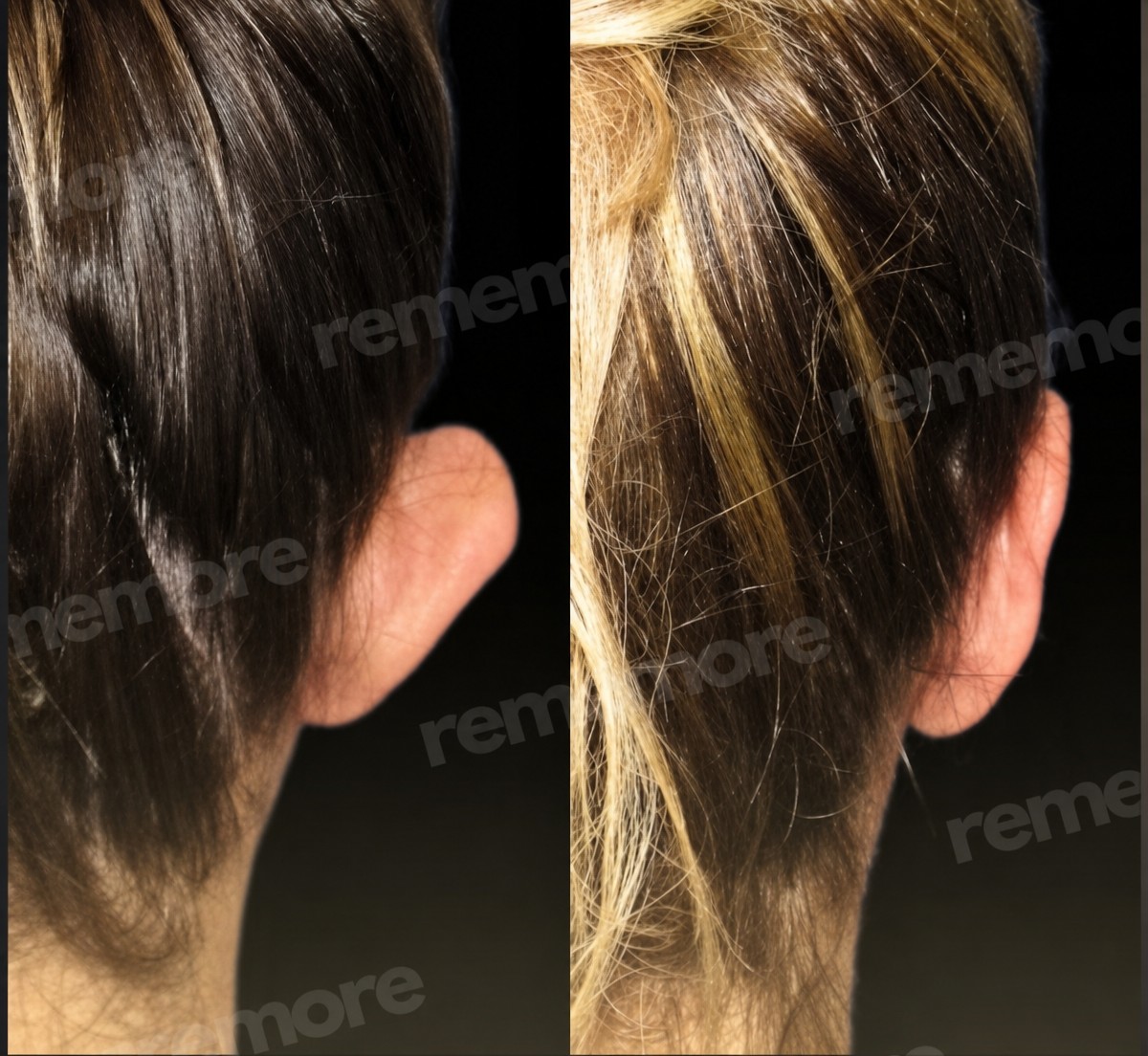 نتائج عملية تجميل الأذن قبل وبعد في مستشفى ميموريال شيشلي، تصحيح شكل الأذن
