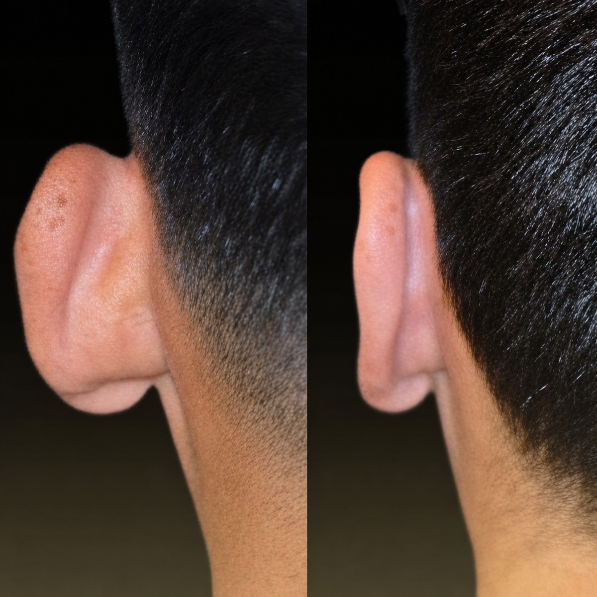 Resultados de otoplastia antes y después en Memorial Şişli Hospital, mejora de oreja