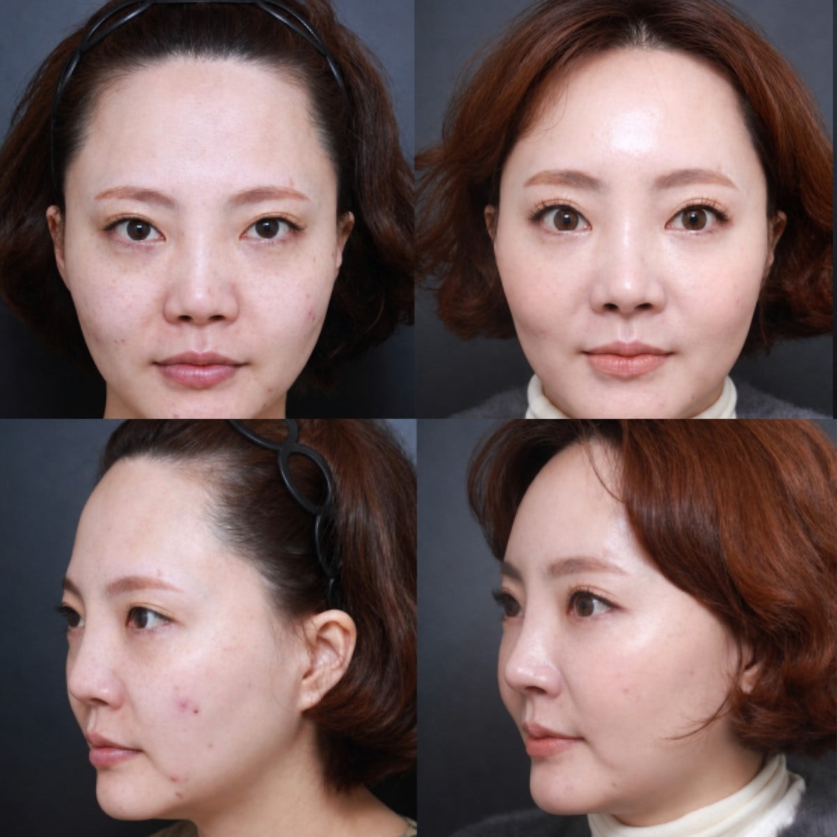 Resultados de lifting de cejas antes y después en VG Plastic Surgery, elevación visible