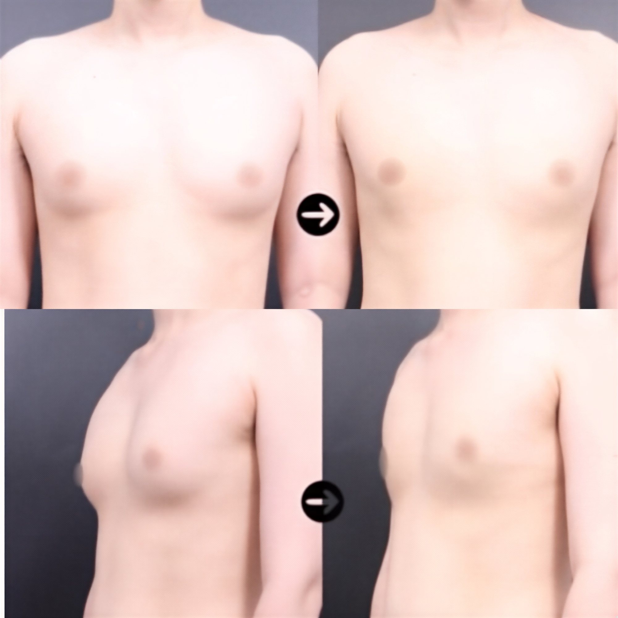 Resultados antes y después de cirugía de ginecomastia en VG Plastic Surgery, contorno masculino
