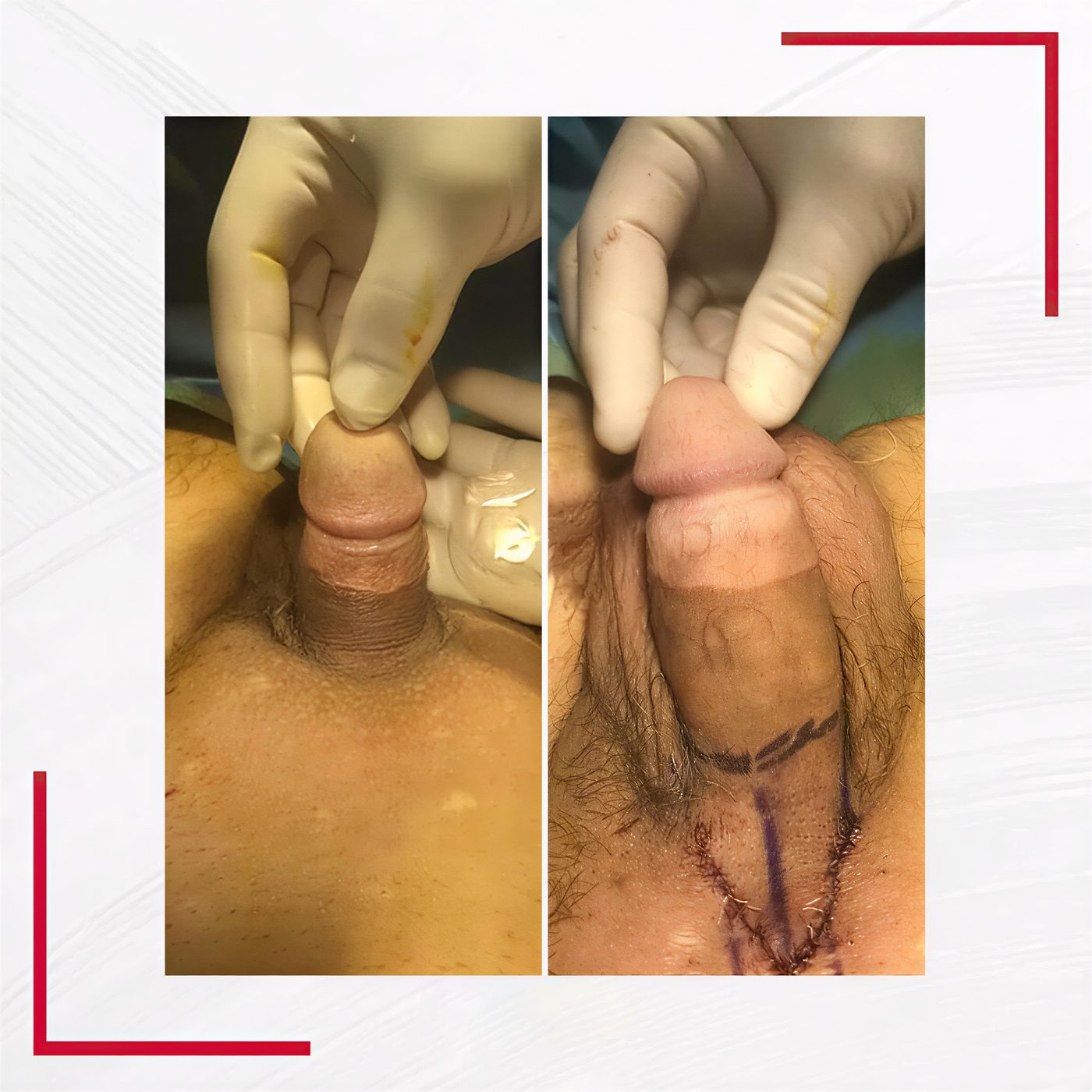 Resultados de alargamiento de pene antes y después en Quartz Hospital, mayor longitud y grosor