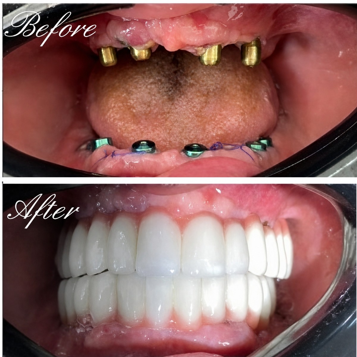 نتائج قبل وبعد زراعة الأسنان All-on-6 في عيادة Morsia Dental، استعادة الابتسامة الكاملة