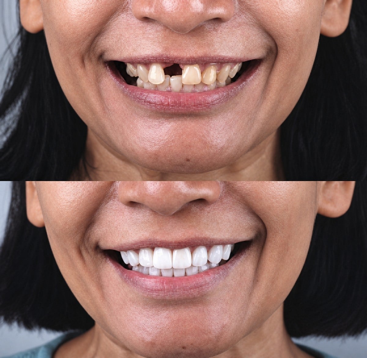 قبل وبعد الفينير في About Tooth Dental Clinic – تحول طبيعي للابتسامة