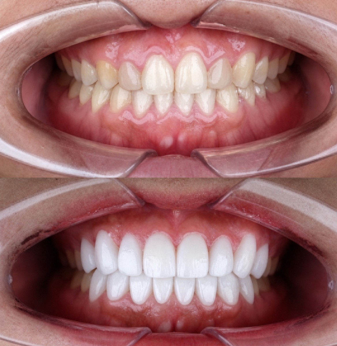 نتائج قبل وبعد الفينير في About Tooth Dental Clinic – ابتسامة أكثر بياضًا وتناسقًا