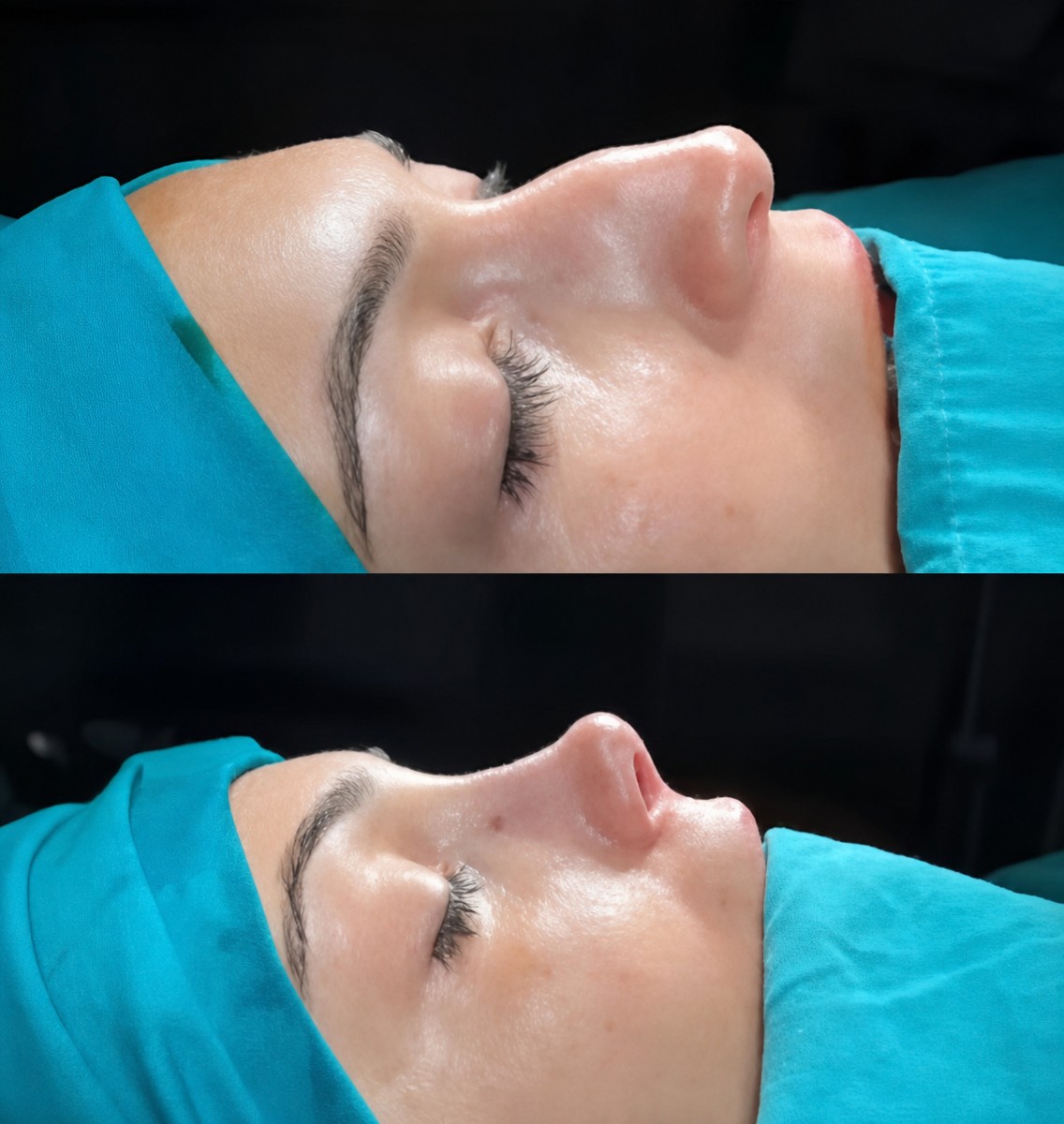 نتيجة عملية تجميل الأنف قبل وبعد في Ento Surgical Medical Center، إعادة تشكيل الأنف