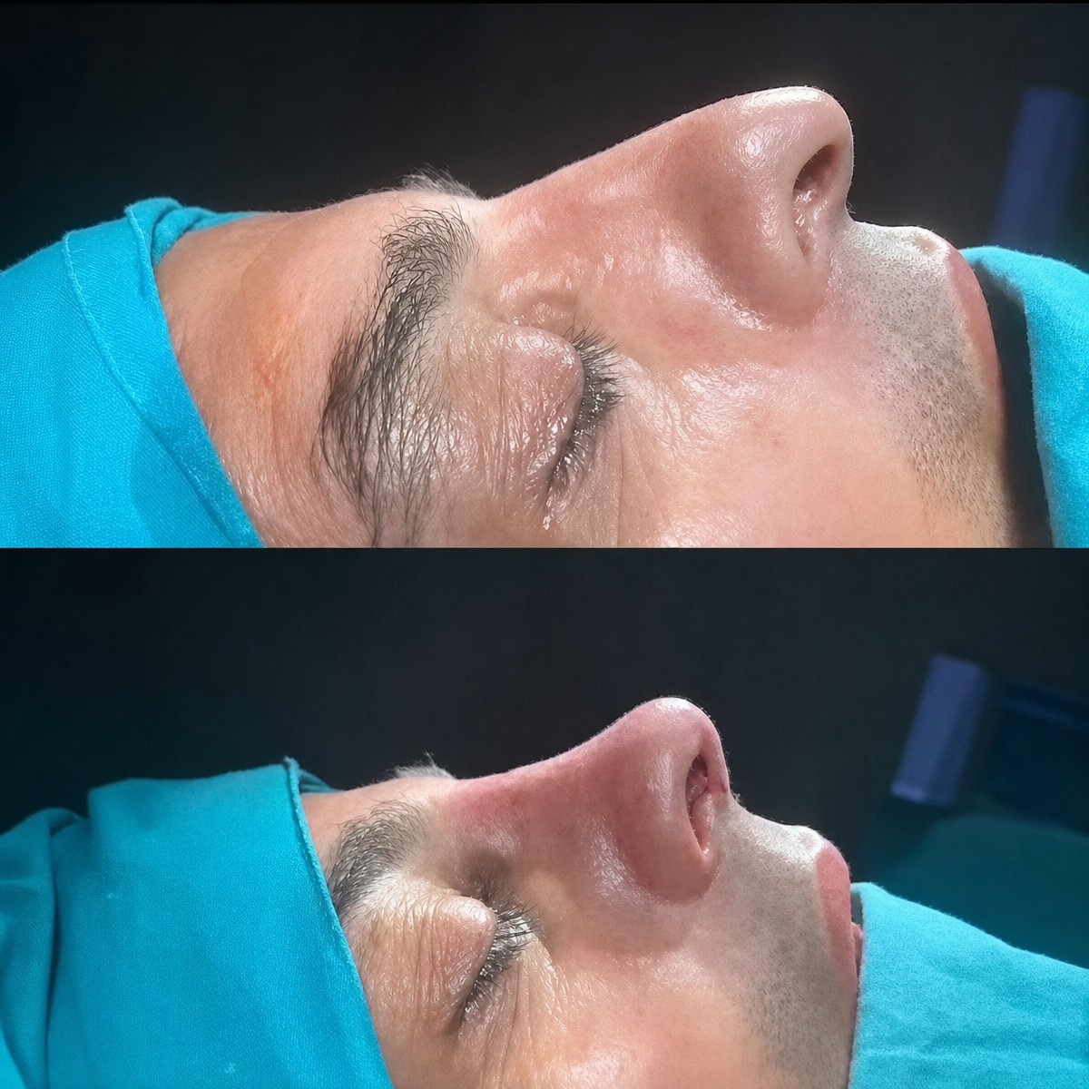 نتائج عملية تجميل الأنف قبل وبعد في Ento Surgical Medical Center، إعادة تشكيل الأنف
