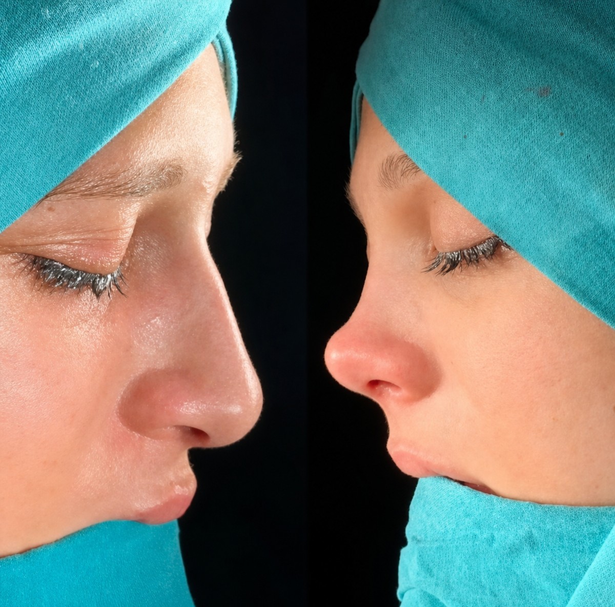 نتائج تجميل الأنف المغلق قبل وبعد في Ento Surgical Medical Center، إعادة تشكيل الأنف