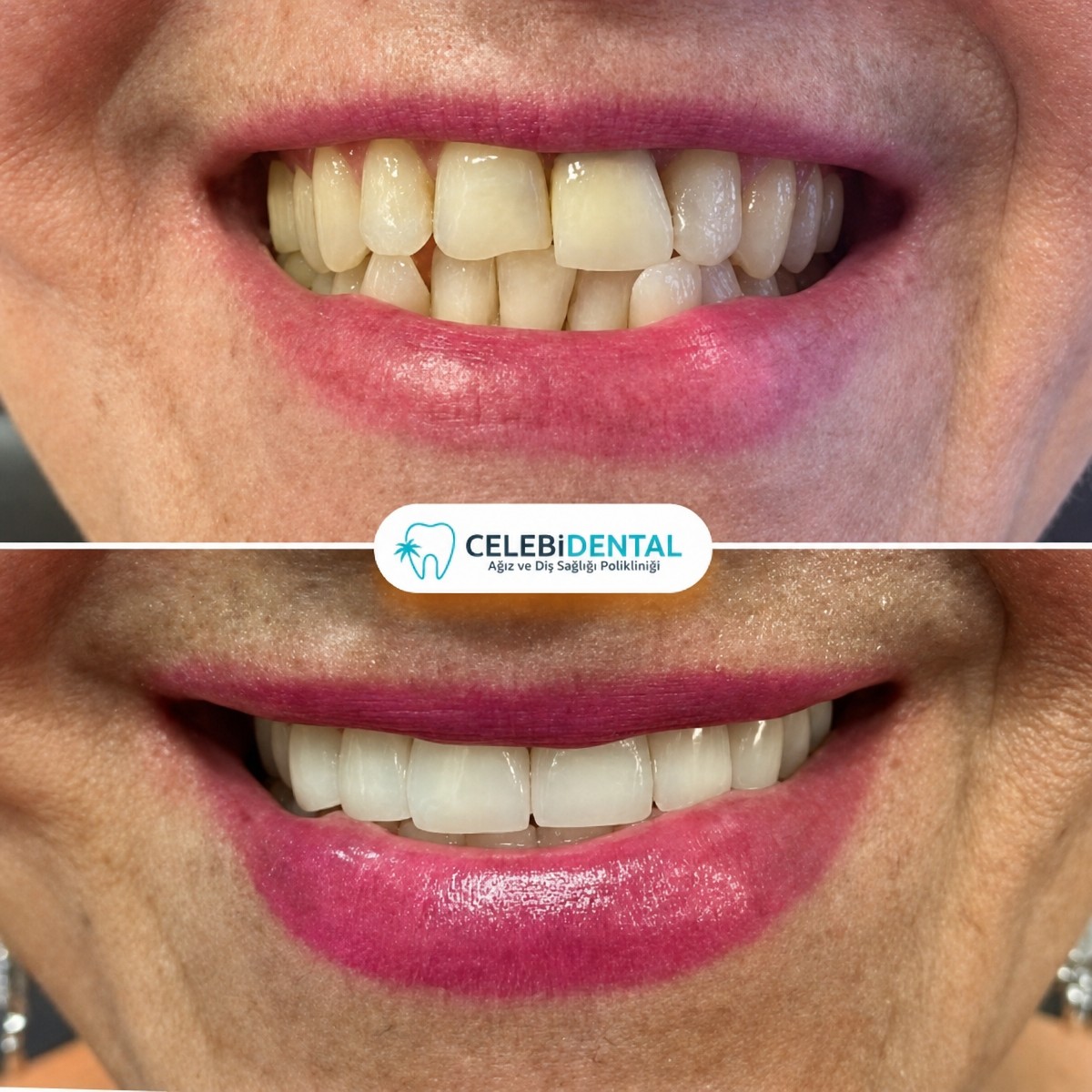 Resultados antes y después de coronas de zirconia en Celebi Dental Clinics – sonrisa mejorada