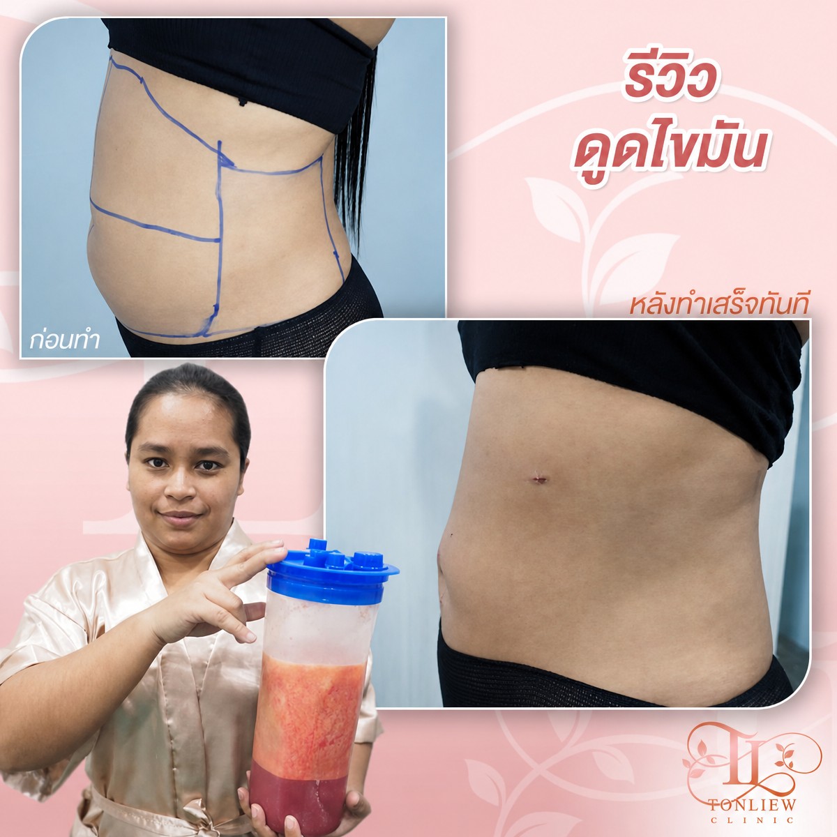 نتائج شفط الدهون قبل وبعد في Tonliew Clinic – تقليل واضح لدهون البطن