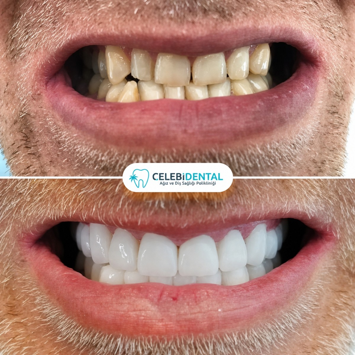 نتيجة قبل وبعد زراعة الأسنان All-on-4 في عيادات Celebi Dental، ابتسامة محسنة