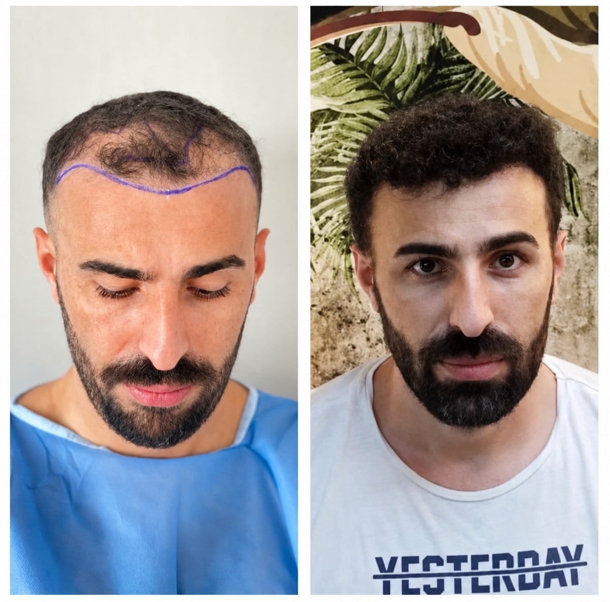 نتائج زراعة الشعر قبل وبعد في Dr. MED – استعادة خط الشعر وكثافة أكبر