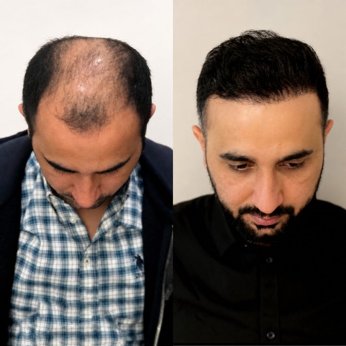 نتائج زراعة الشعر قبل وبعد في Dr. MED – استعادة خط الشعر وكثافة الشعر