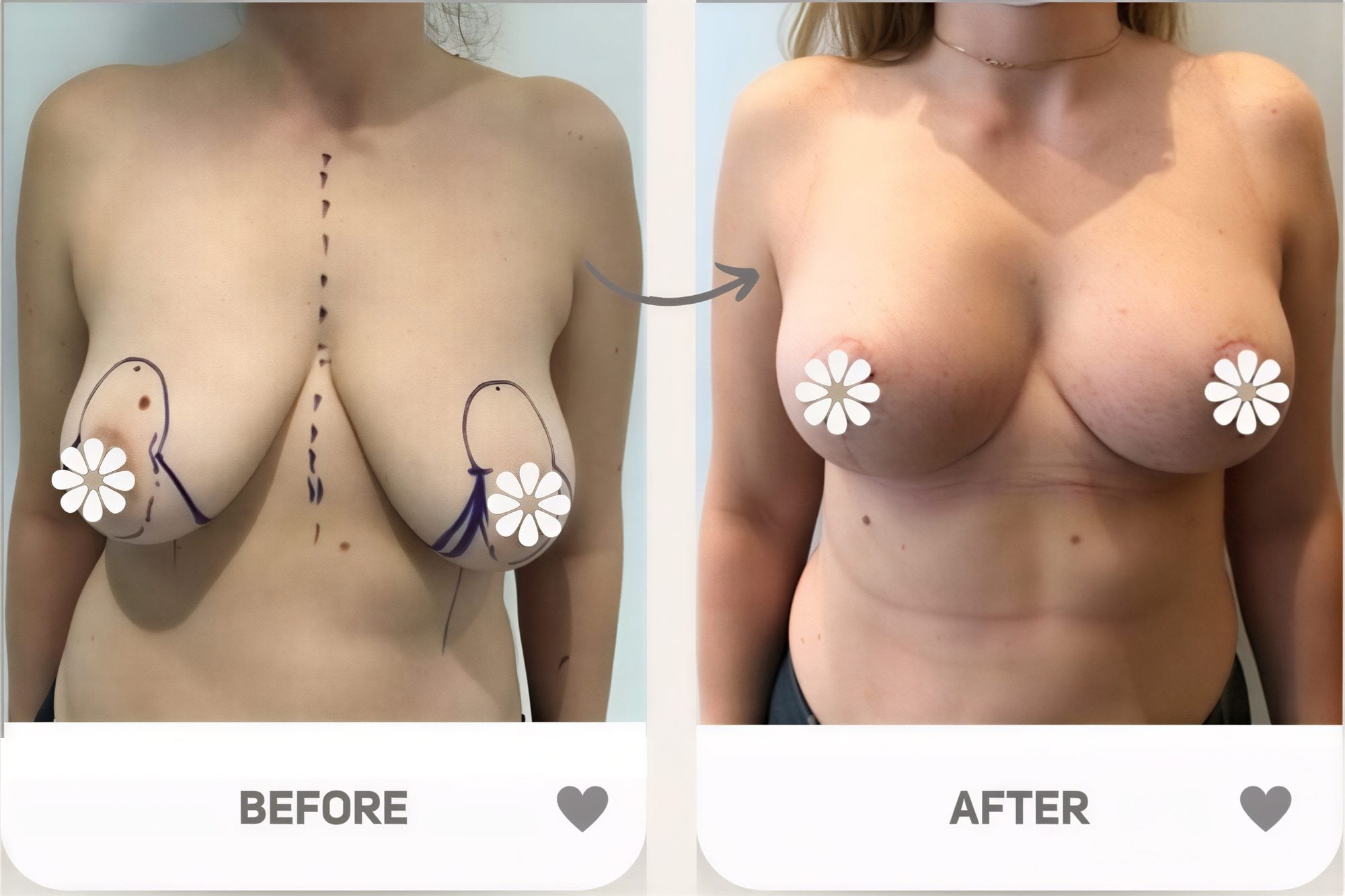 Resultados antes y después de lifting de senos en KCM Clinic: mejor forma y contorno