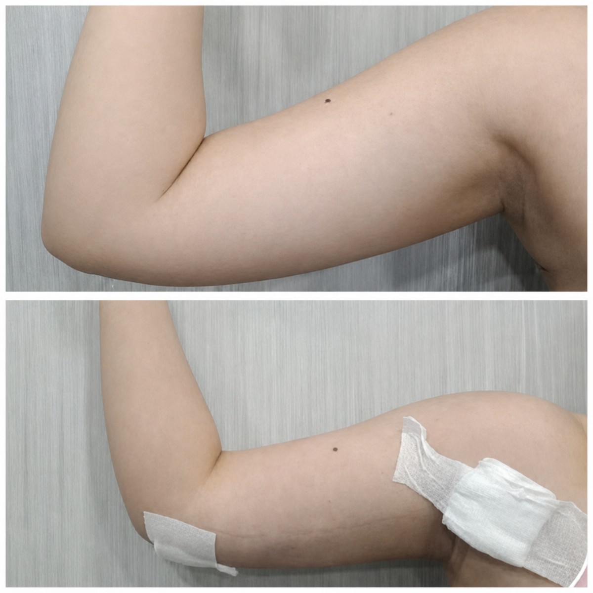 نتائج شفط دهون الذراع قبل وبعد في Tonliew Clinic، تحسين واضح لشكل الذراع