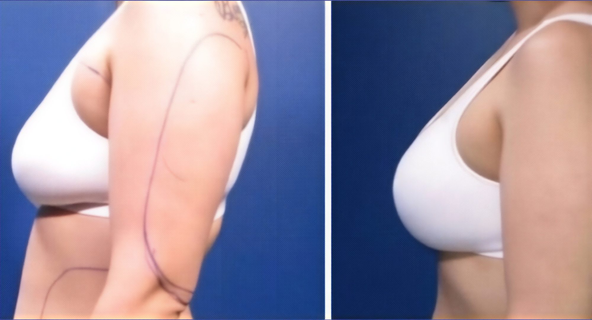نتائج عملية تكبير الثدي قبل وبعد في ID Clinic Bangkok – تحسين شكل وحجم الثدي