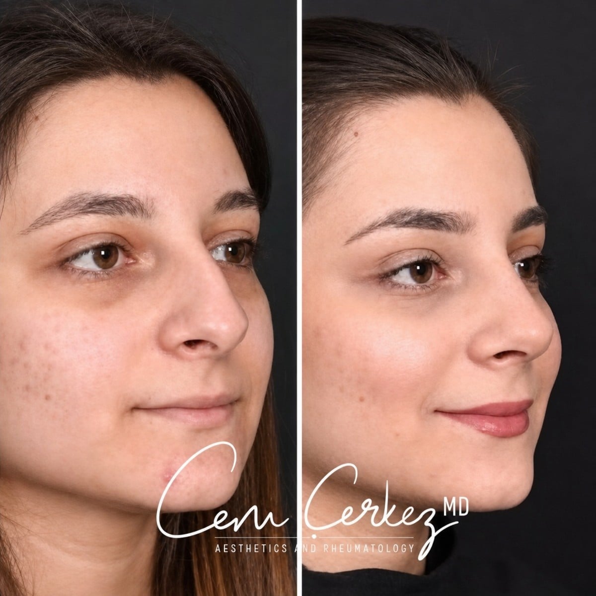 نتائج تجميل الأنف قبل وبعد في RENOVIUM CLINIC BY CEM CERKEZ MD، إعادة تشكيل الأنف