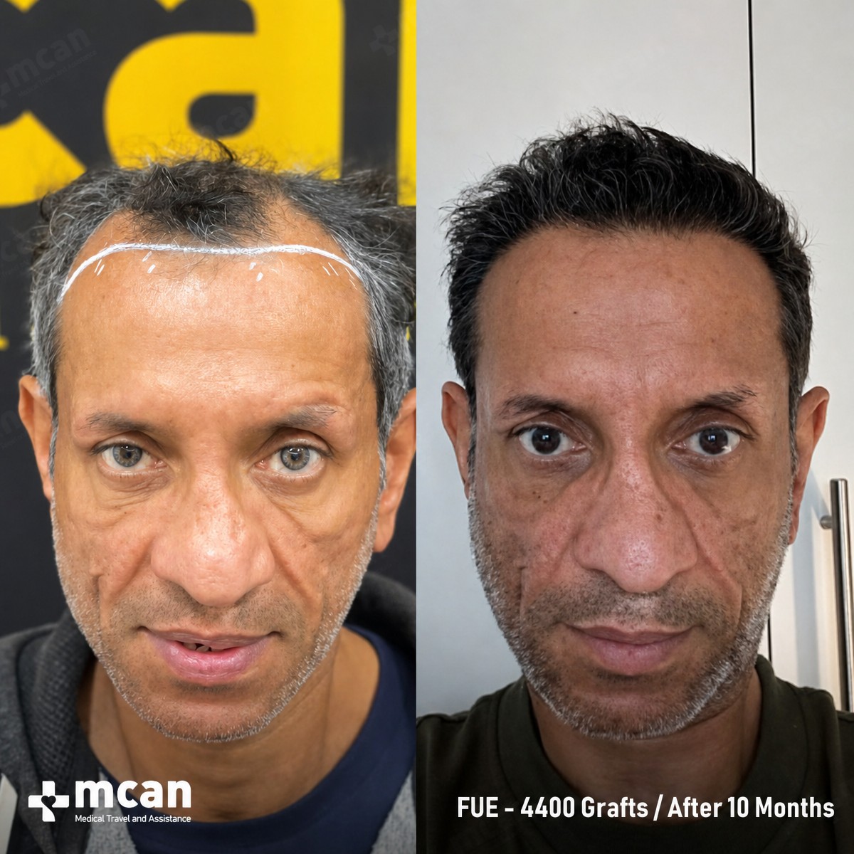 Resultados de trasplante capilar FUE en MCAN Health, 4400 injertos, 10 meses